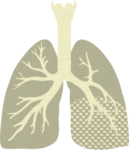 A depiction of a pair of lungs with pneumonia in yellow with an inflamed lobe